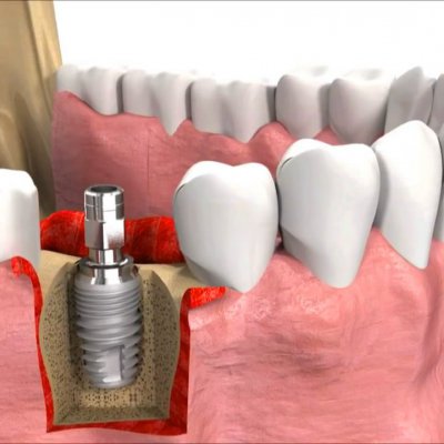 Implant tedavisi nedir? Hangi durumlarda uygulanır?