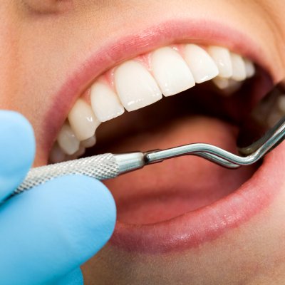 Endodonti (Kanal Tedavisi) uygulaması nasıl yapılır?